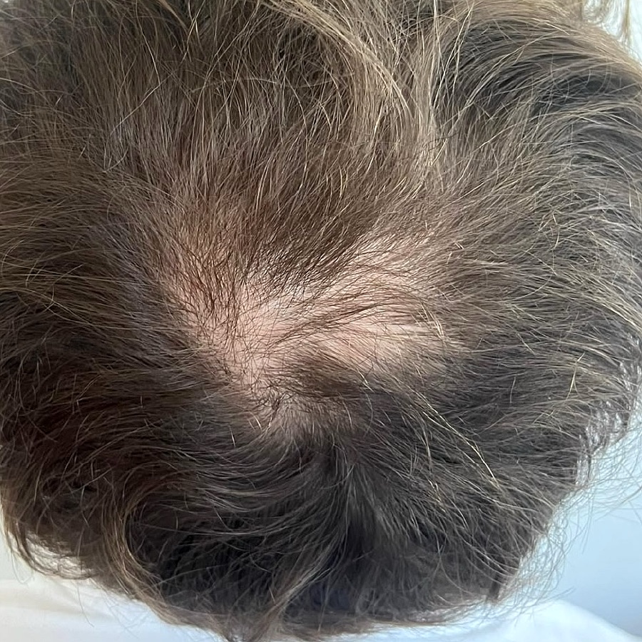 Top view of a scalp with diffuse thinning at the crown